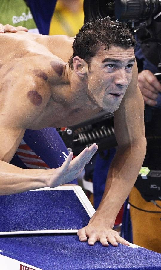 Así son los moratones de Phelps