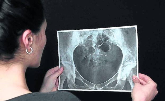 Denuncian daños en 25.000 pacientes por implantes en España desde 2008