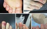Imágenes de las erupciones en los dedos de los pies de adolescentes que el Consejo General de Colegios Oficiales de Podólogos atribuye al coronavirus./C. G. C. O. P.