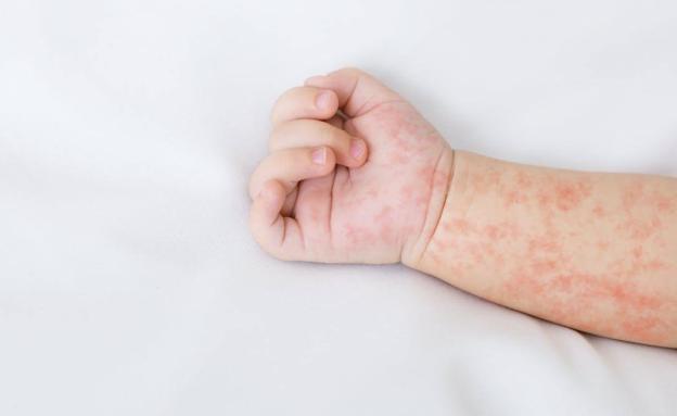 Los casos de sarampión no paran de crecer en todo el mundo: ¿qué está ocurriendo?
