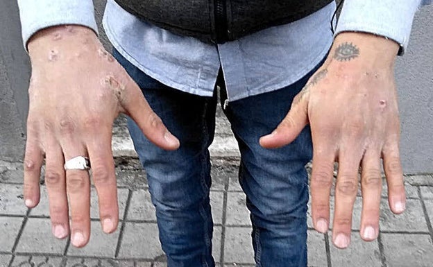 Los rastreadores del covid se incorporan al control de la sarna en Euskadi