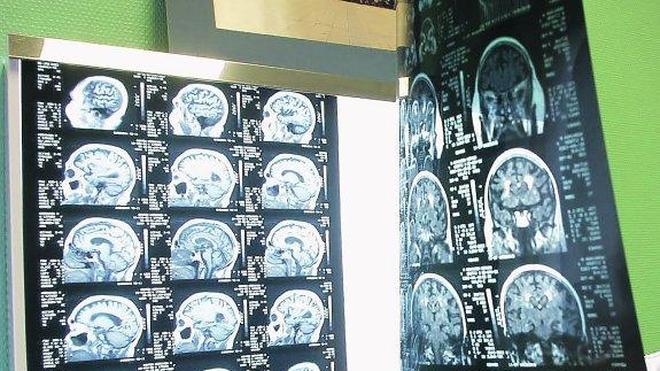 En busca de las raíces vascas del Parkinson para encontrar una cura