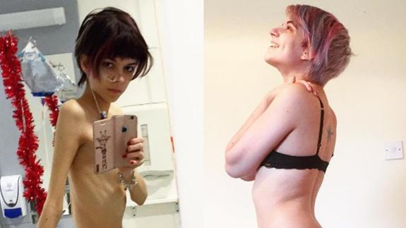 Las fotos de la joven que demuestra que sí se puede salir de la anorexia