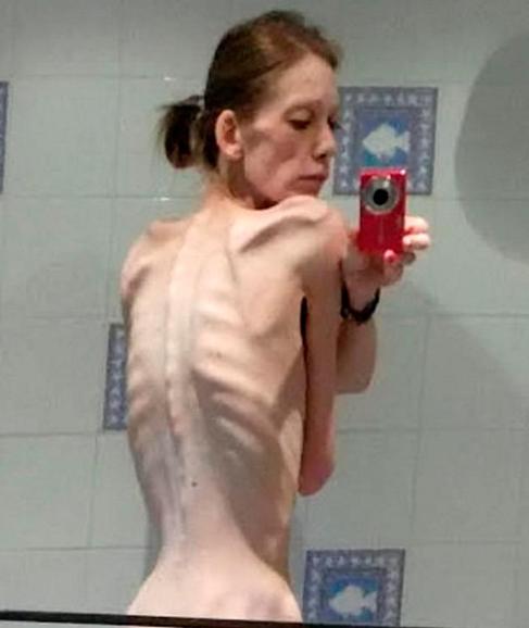 De estar a punto de morir a campeona de fisicoculturismo, así superó Nicola King la anorexia